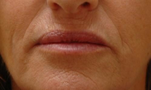 Lip Augmentation Before and After Pictures Fort Lauderdale, FL