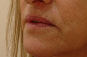 Lip Augmentation Before and After Pictures Fort Lauderdale, FL