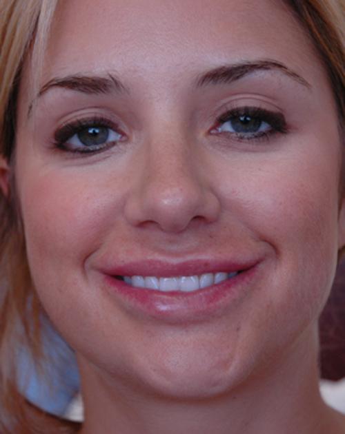 lip-augmentation-10 Lip Augmentation Before and After Pictures Fort Lauderdale, FL