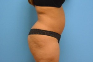 Liposuction Before and After Pictures Fort Lauderdale, FL