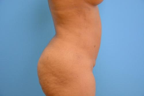 Liposuction Before and After Pictures Fort Lauderdale, FL