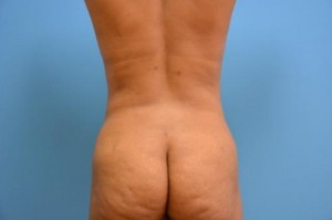 Liposuction Before and After Pictures Fort Lauderdale, FL