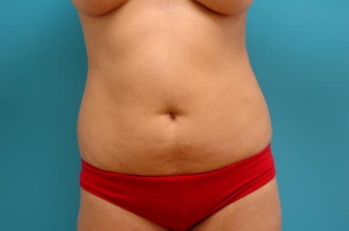 liposuction-05 Liposuction Before and After Pictures Fort Lauderdale, FL
