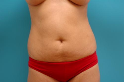 Liposuction Before and After Pictures Fort Lauderdale, FL