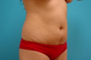 Liposuction Before and After Pictures Fort Lauderdale, FL