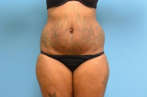 Liposuction Before and After Pictures Fort Lauderdale, FL