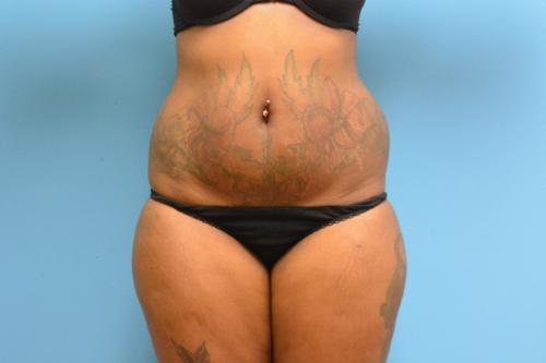 liposuction-09 Liposuction Before and After Pictures Fort Lauderdale, FL