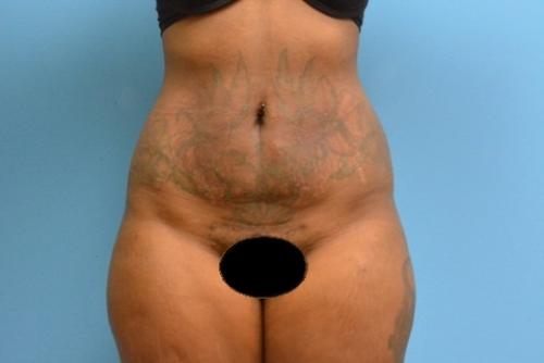 Liposuction Before and After Pictures Fort Lauderdale, FL