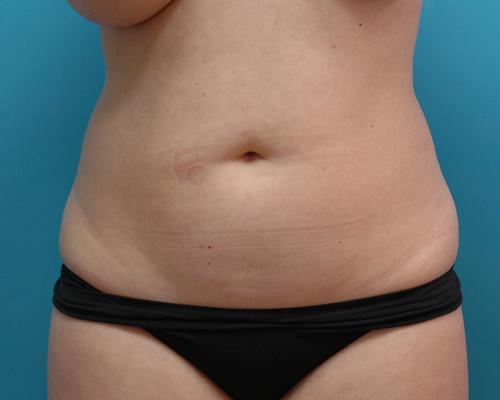 Liposuction Before and After Pictures Fort Lauderdale, FL