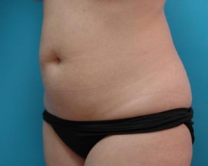 Liposuction Before and After Pictures Fort Lauderdale, FL