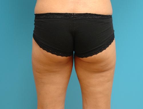 Liposuction Before and After Pictures Fort Lauderdale, FL