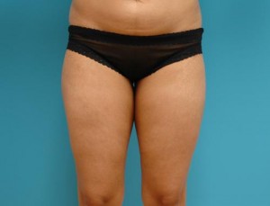 Liposuction Before and After Pictures Fort Lauderdale, FL