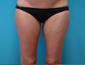 Liposuction Before and After Pictures Fort Lauderdale, FL