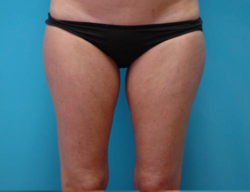 liposuction-21 Liposuction Before and After Pictures Fort Lauderdale, FL