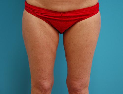 liposuction-22 Liposuction Before and After Pictures Fort Lauderdale, FL