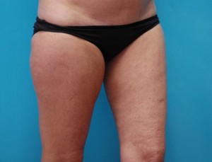Liposuction Before and After Pictures Fort Lauderdale, FL
