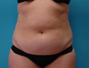 Liposuction Before and After Pictures Fort Lauderdale, FL