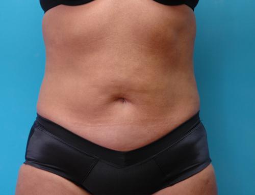 Liposuction Before and After Pictures Fort Lauderdale, FL