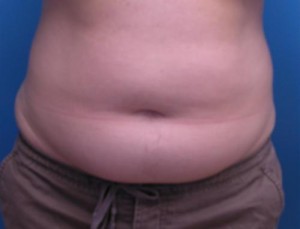 Liposuction Before and After Pictures Fort Lauderdale, FL