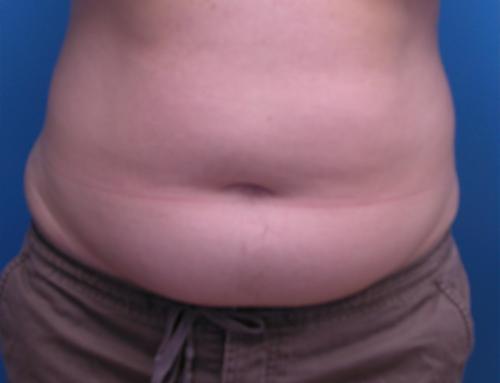 Liposuction Before and After Pictures Fort Lauderdale, FL