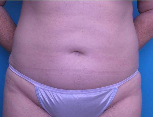 Liposuction Before and After Pictures Fort Lauderdale, FL