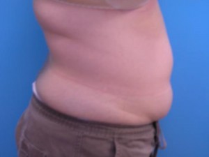 Liposuction Before and After Pictures Fort Lauderdale, FL