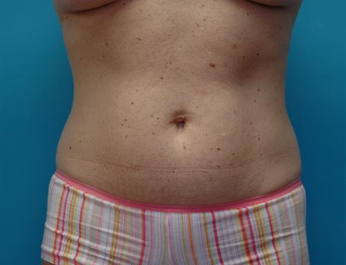 Liposuction Before and After Pictures Fort Lauderdale, FL