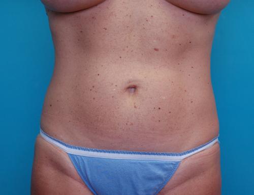 Liposuction Before and After Pictures Fort Lauderdale, FL