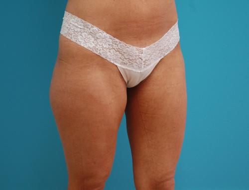 liposuction-41 Liposuction Before and After Pictures Fort Lauderdale, FL