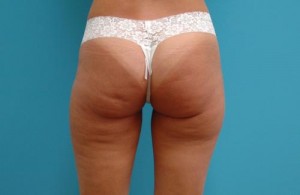 Liposuction Before and After Pictures Fort Lauderdale, FL