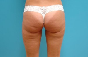 Liposuction Before and After Pictures Fort Lauderdale, FL