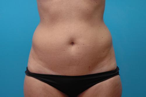 Liposuction Before and After Pictures Fort Lauderdale, FL