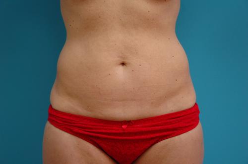 Liposuction Before and After Pictures Fort Lauderdale, FL