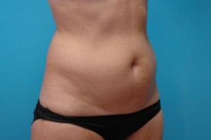 Liposuction Before and After Pictures Fort Lauderdale, FL