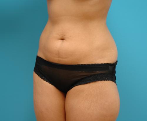 liposuction-49 Liposuction Before and After Pictures Fort Lauderdale, FL