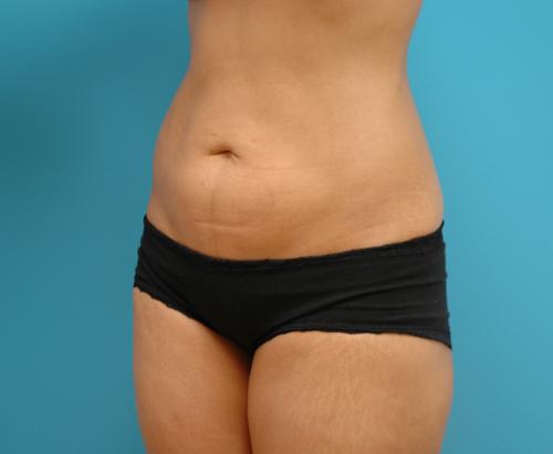 Liposuction Before and After Pictures Fort Lauderdale, FL