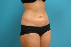 Liposuction Before and After Pictures Fort Lauderdale, FL