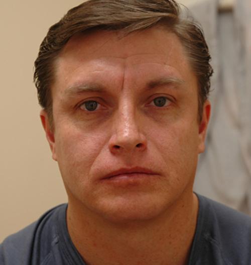 male-botox-dysport-01 Injectable Fillers Before and After Pictures Fort Lauderdale, FL