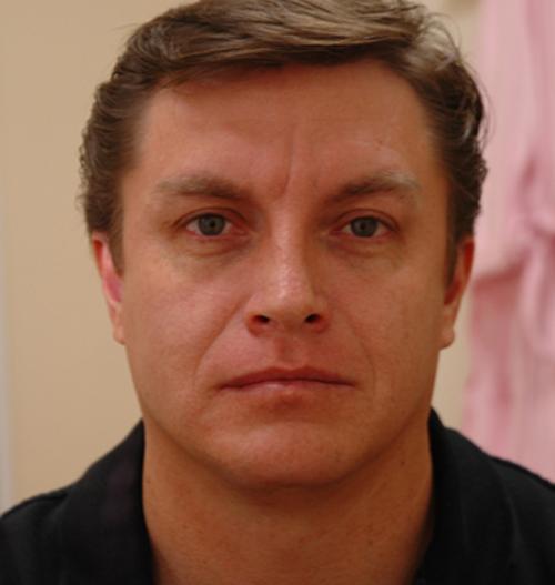 male-botox-dysport-02 Injectable Fillers Before and After Pictures Fort Lauderdale, FL