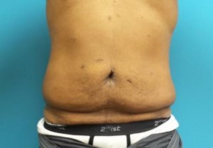 After Massive Weight Loss Before and After Pictures Fort Lauderdale, FL