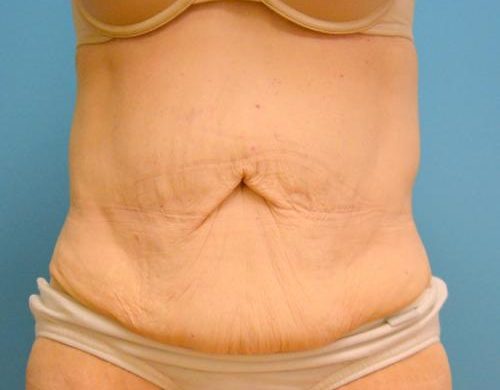 After Massive Weight Loss Before and After Pictures Fort Lauderdale, FL