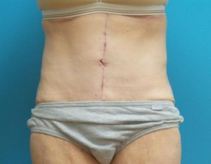 After Massive Weight Loss Before and After Pictures Fort Lauderdale, FL