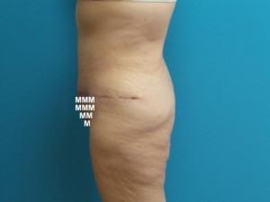 After Massive Weight Loss Before and After Pictures Fort Lauderdale, FL