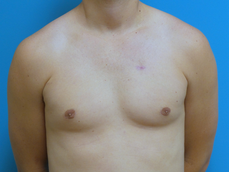 Gynecomastia Before and After Pictures Fort Lauderdale, FL