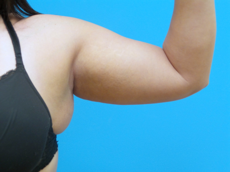 PatientFile_2619383 Liposuction Before and After Pictures Fort Lauderdale, FL