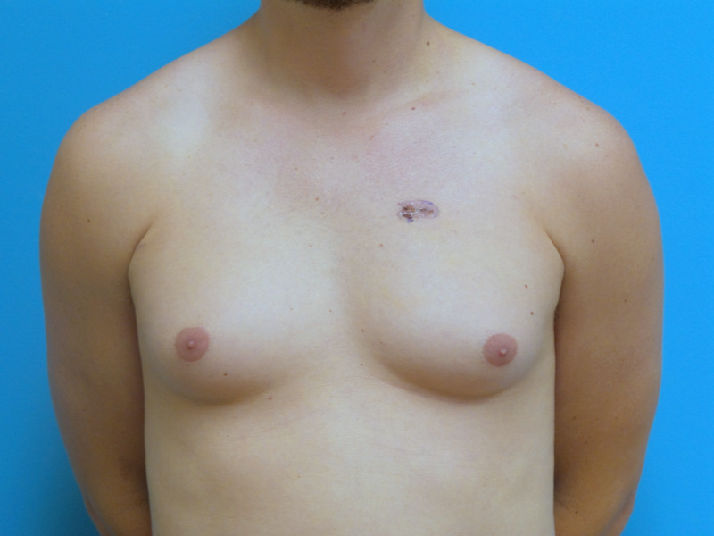 Gynecomastia Before and After Pictures Fort Lauderdale, FL