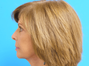 Facelift Before and After Pictures Fort Lauderdale, FL