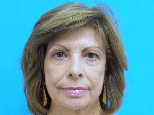 Facelift Before and After Pictures Fort Lauderdale, FL