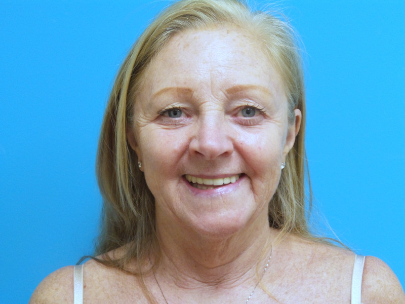 Face-Lift-61 Facelift Before and After Pictures Fort Lauderdale, FL