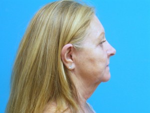 Facelift Before and After Pictures Fort Lauderdale, FL